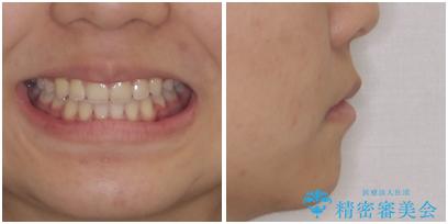 気がつくと口が開いてしまう 閉じにくい口元改善の抜歯矯正の治療後(顔貌)