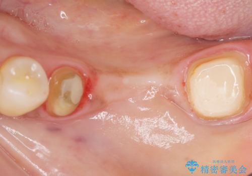 歯が痛い 深いう蝕により神経が死んでいる 50代女性の治療中