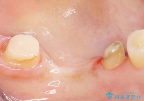 歯が痛い 深いう蝕により神経が死んでいる 50代女性の治療中