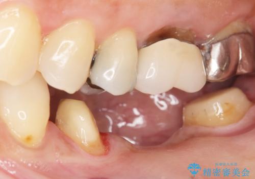 歯が痛い 深いう蝕により神経が死んでいる 50代女性の治療中