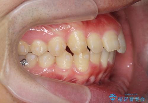 [ インビザライン ] マウスピース矯正で治す出っ歯の治療の治療中