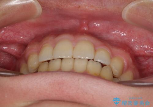 前歯のクロスバイトと抜歯が必要な奥歯の虫歯　インビザラインとインプラント治療の治療中