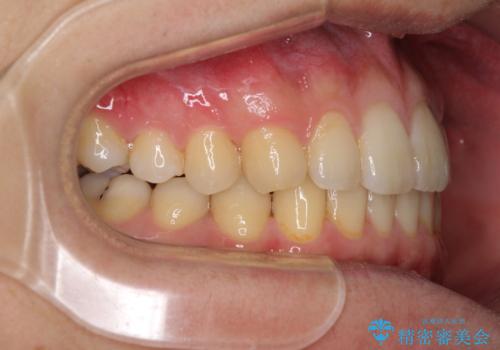 前歯のクロスバイトと抜歯が必要な奥歯の虫歯 インビザラインとインプラント治療の治療中