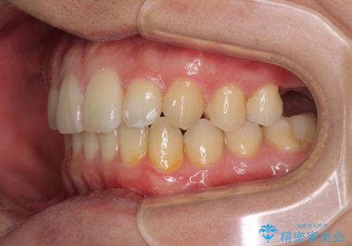 前歯のクロスバイトと抜歯が必要な奥歯の虫歯 インビザラインとインプラント治療の治療中