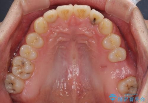 前歯のクロスバイトと抜歯が必要な奥歯の虫歯 インビザラインとインプラント治療の治療中