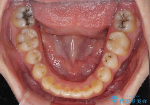 前歯のクロスバイトと抜歯が必要な奥歯の虫歯 インビザラインとインプラント治療の治療中