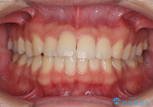 インビザライン・ライトによる矯正治療の後戻り改善の症例 治療前