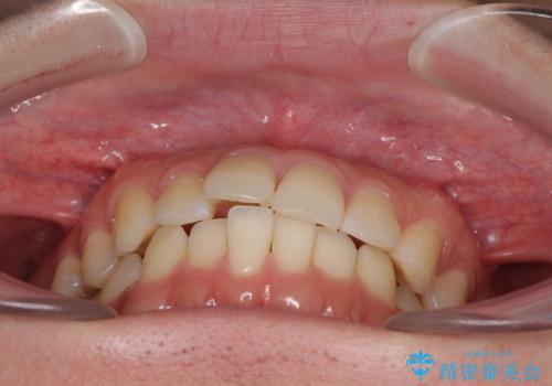インビザライン・ライトによる矯正治療の後戻り改善の治療前