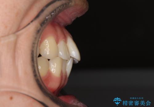 インビザライン・ライトによる矯正治療の後戻り改善の治療前