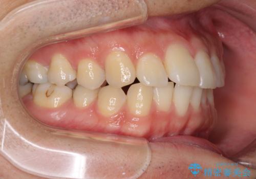 インビザライン・ライトによる矯正治療の後戻り改善の治療前