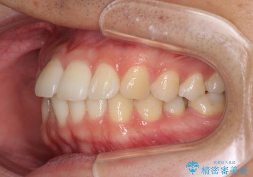 インビザライン・ライトによる矯正治療の後戻り改善の治療前