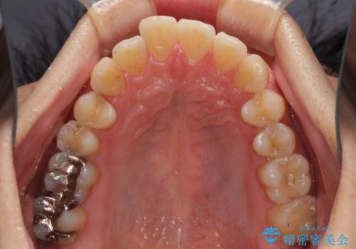インビザライン・ライトによる矯正治療の後戻り改善の治療前