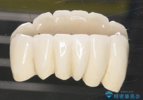 他院で抜歯と言われた歯 歯も神経も残したい 50代男性の治療後