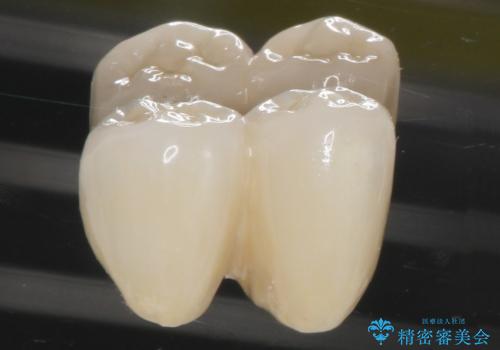 歯がぐらぐら 再生療法で抜かずに残す 50代男性の治療後