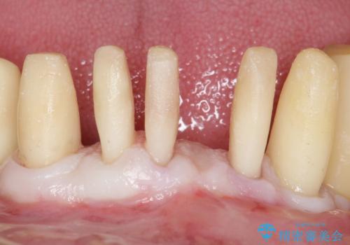 他院で抜歯と言われた歯 歯も神経も残したい 50代男性の治療後