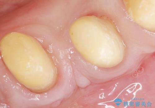 歯がぐらぐら 再生療法で抜かずに残す 50代男性の治療中