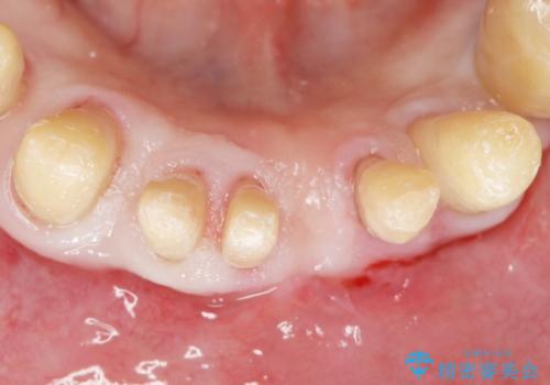他院で抜歯と言われた歯 歯も神経も残したい 50代男性の治療後
