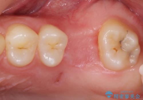 前歯のクロスバイトと抜歯が必要な奥歯の虫歯 インビザラインとインプラント治療の治療前