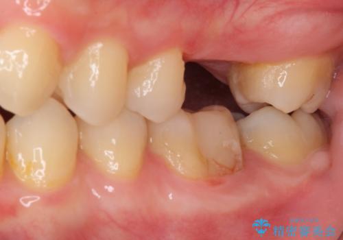 前歯のクロスバイトと抜歯が必要な奥歯の虫歯 インビザラインとインプラント治療の治療前