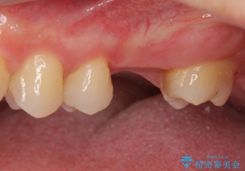 前歯のクロスバイトと抜歯が必要な奥歯の虫歯 インビザラインとインプラント治療の治療前