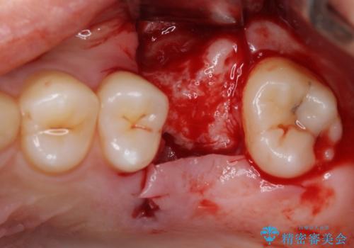 前歯のクロスバイトと抜歯が必要な奥歯の虫歯 インビザラインとインプラント治療の治療前
