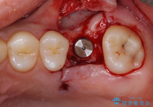 前歯のクロスバイトと抜歯が必要な奥歯の虫歯 インビザラインとインプラント治療の治療中