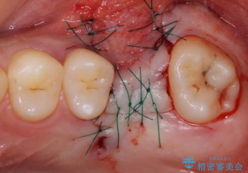 前歯のクロスバイトと抜歯が必要な奥歯の虫歯 インビザラインとインプラント治療の治療後