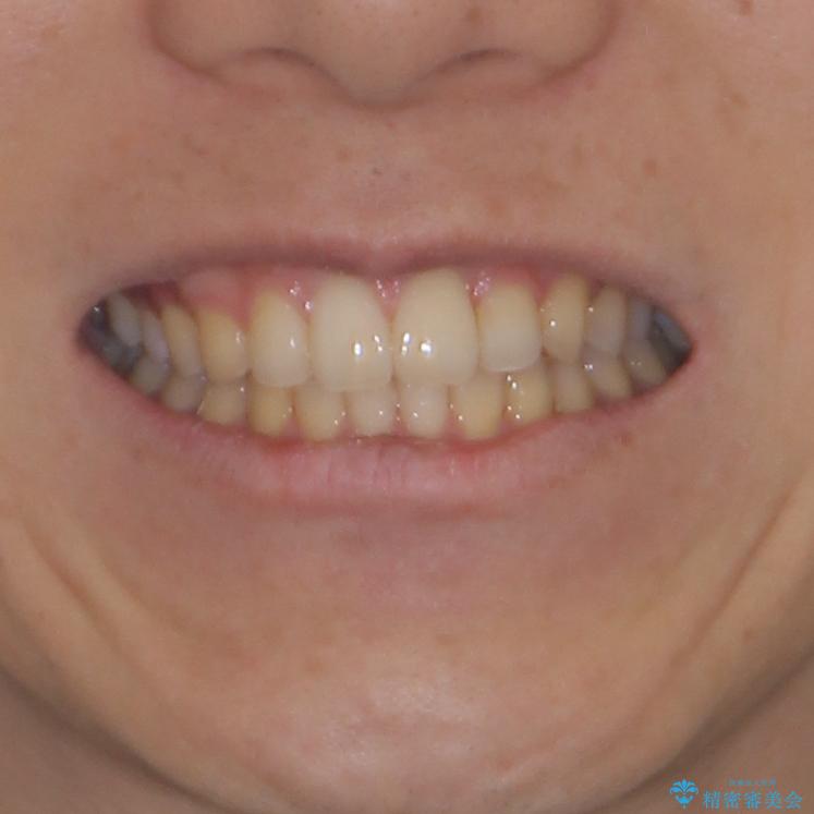 前歯のクロスバイトと抜歯が必要な奥歯の虫歯 インビザラインとインプラント治療の治療後(顔貌)