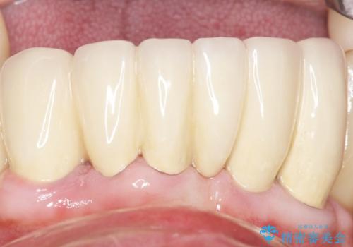 他院で抜歯と言われた歯 歯も神経も残したい 50代男性の治療後