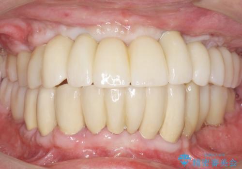 他院で抜歯と言われた歯 歯も神経も残したい 50代男性の治療後