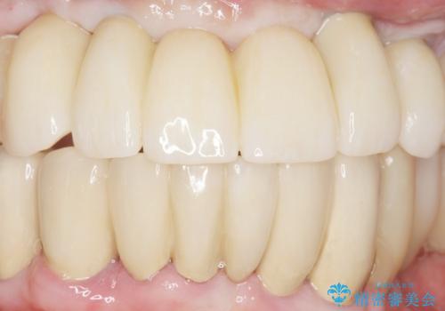 喫煙を再開してインプラント周囲炎に リカバリー治療 50代男性の治療後