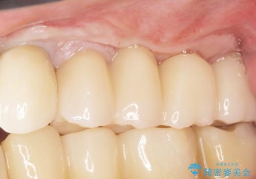 歯肉移植(FGG)による角化歯肉の獲得で長持ちするインプラントへ 50代男性の治療後