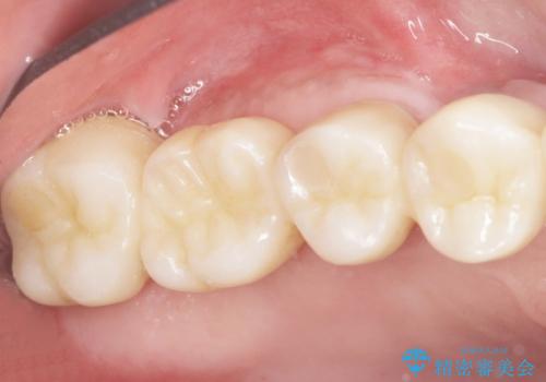 骨が薄く難しい上の奥歯のインプラント　50代男性の症例 治療後