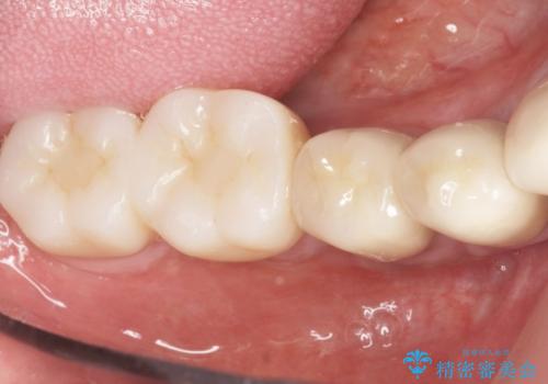 歯がぐらぐら 再生療法で抜かずに残す 50代男性の治療後