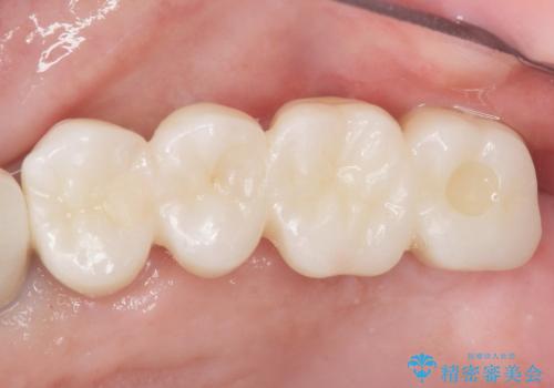 歯肉移植(FGG)による角化歯肉の獲得で長持ちするインプラントへ　50代男性の症例 治療後