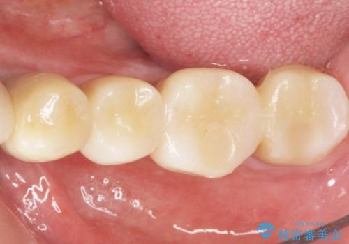 歯がぐらぐらで咬めない　奥歯のインプラント　50代男性の症例 治療後