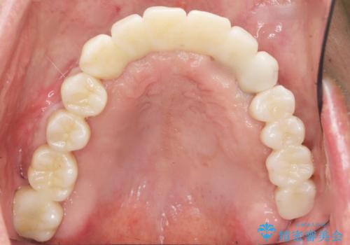 喫煙を再開してインプラント周囲炎に リカバリー治療 50代男性の治療後