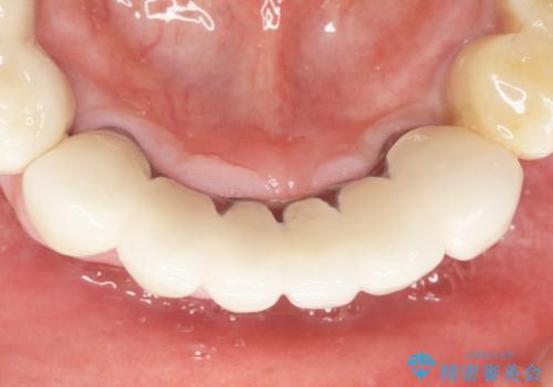 他院で抜歯と言われた歯 歯も神経も残したい 50代男性の治療後