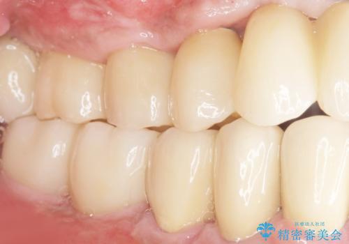 歯がぐらぐら 再生療法で抜かずに残す 50代男性の治療後