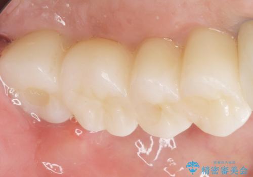 歯肉移植(FGG)による角化歯肉の獲得で長持ちするインプラントへ 50代男性の治療後