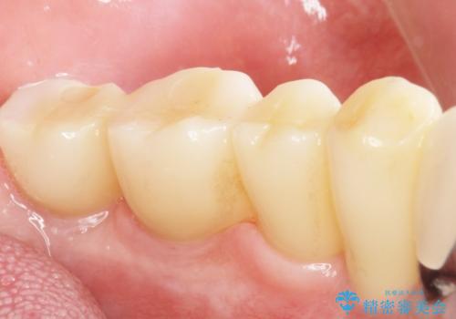 歯がぐらぐらで咬めない 奥歯のインプラント 50代男性の治療後