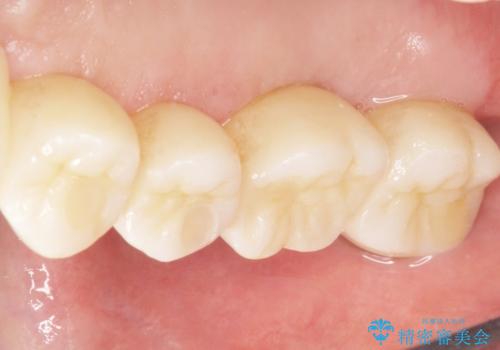 骨が薄く難しい上の奥歯のインプラント 50代男性の治療後