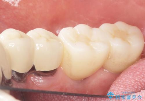歯がぐらぐら 再生療法で抜かずに残す 50代男性の治療後