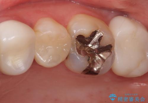 銀歯の下が虫歯になっている セラミックインレー 30代女性の治療前