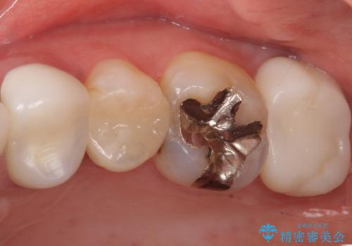 銀歯の下が虫歯になっている　セラミックインレー　30代女性