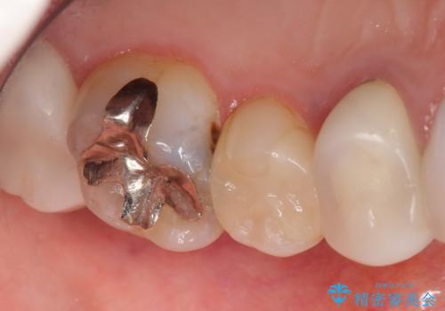 銀歯の下が虫歯になっている セラミックインレー 30代女性の治療前