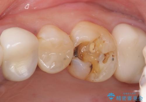 銀歯の下が虫歯になっている セラミックインレー 30代女性の治療前