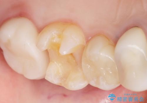 銀歯の下が虫歯になっている　セラミックインレー　30代女性の治療中