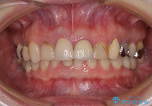 鼻の下を押すと痛い 抜歯を避けてきた歯を抜歯して自然な口元にの治療前