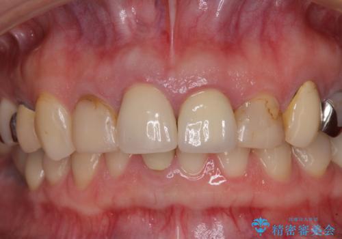 鼻の下を押すと痛い 抜歯を避けてきた歯を抜歯して自然な口元にの治療前